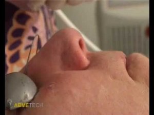 Лазерное удаление сосудов и гемангиом лазером Fotona