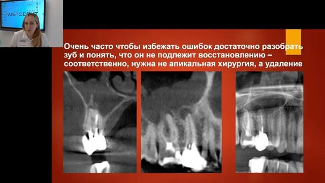 ПОВТОРНАЯ ЭНДОДОНТИЯ ИЛИ АПИКАЛЬНАЯ ХИРУРГИЯ.ЧТО ВЫБРАТЬ смотреть онлайн