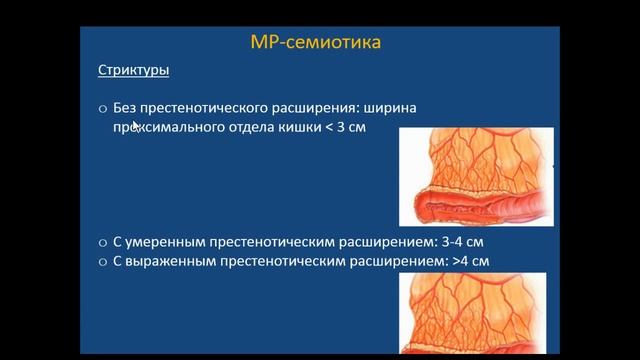Ключникова Е.И. «МР-энтерография в диагностике болезни Крона» смотреть онлайн