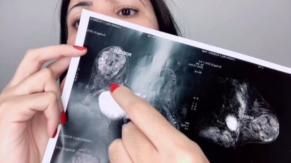 Bi rads 4 meu testemunho! Birads