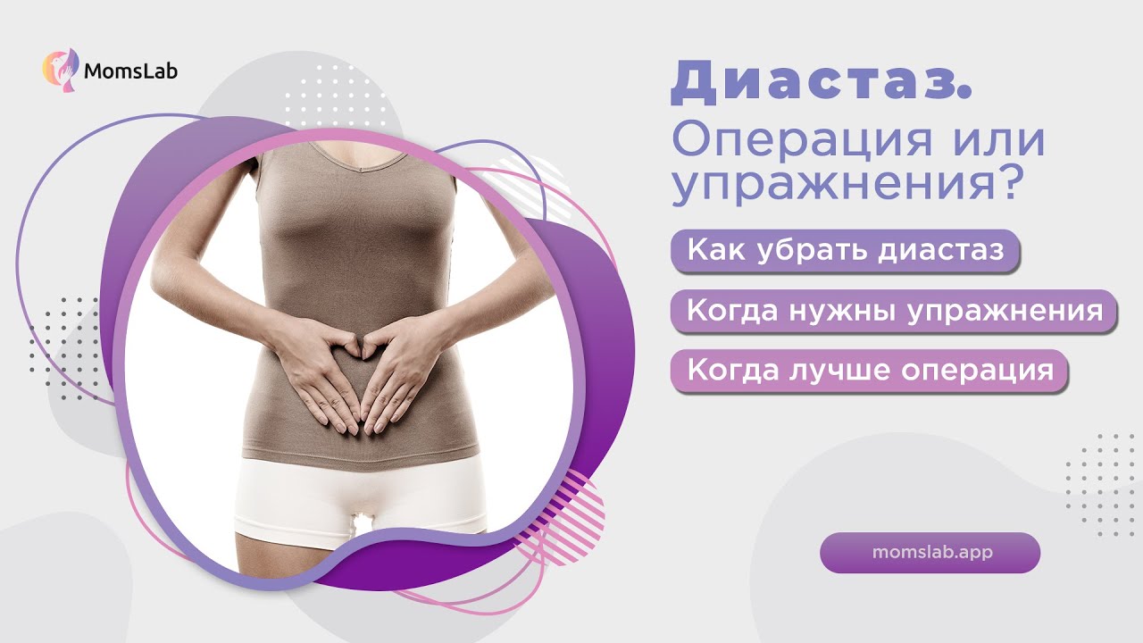 Диастаз. Операция или упражнения?