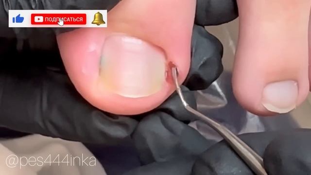 Вросший ноготь у ребенка/ воспаление на пальце/ прием у подолога смотреть онлайн