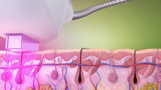 Фотоэпиляция. смотреть онлайн