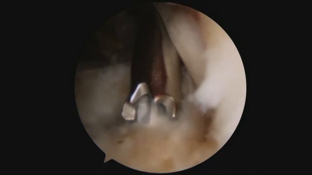 Arthroscopic Tenodesis of the Long Head of the Biceps Tendon смотреть онлайн