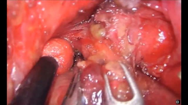 Asvide: Left paratracheal lymph node dissection смотреть онлайн