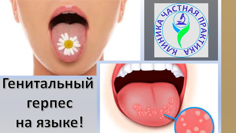 Генитальный герпес на языке смотреть онлайн
