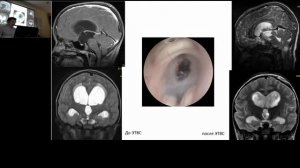Заседание московского общества нейрохирургов