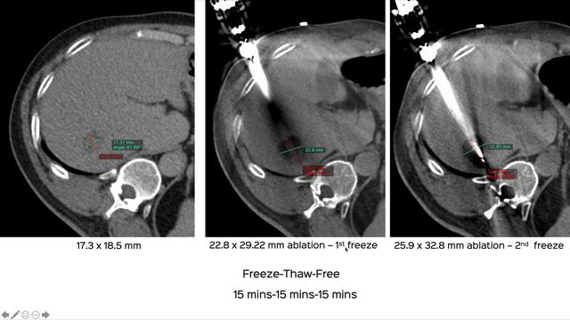 Case 52 Cryoablation of Liver Metastasis смотреть онлайн