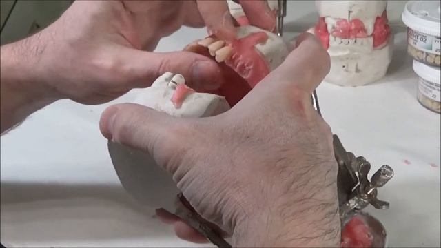 Изготовление Съёмных зубных протезов. Изготовление кламмеров. Постановка зубов.