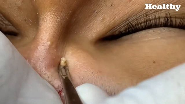 Best Pimple Popping Videos Large Blackheads Remove Blackheads Ep 2 смотреть онлайн