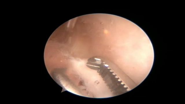 Удаление свободного внутрисуставного тела (кусочка хряща) из коленного сустава смотреть онлайн