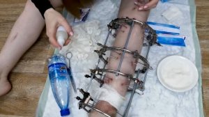 Как сделать перевязку. Аппарат Илизарова Как перевязать голень в аппарате Илизарова?!