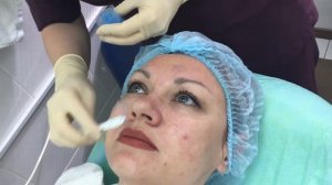 ПИЛИНГ ЛИЦА. Поверхностный пилинг. ДО и ПОСЛЕ. SPF 50 защита.КАК ВЫБРАТЬ?