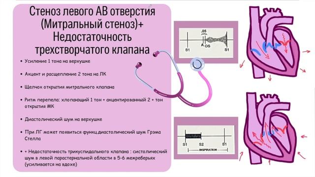 Аускультация сердца (Часть 1): Узнай патологию // Звуки на симуляторе смотреть онлайн