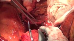 трансплантация печени ГКБ 7 УЗ г  Алматы