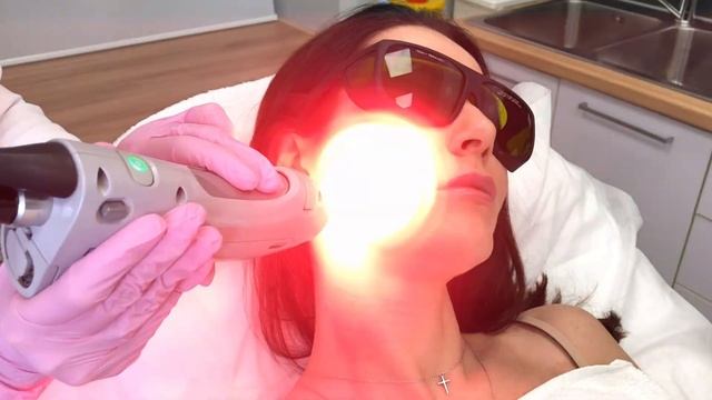 Эпиляция лица лазером