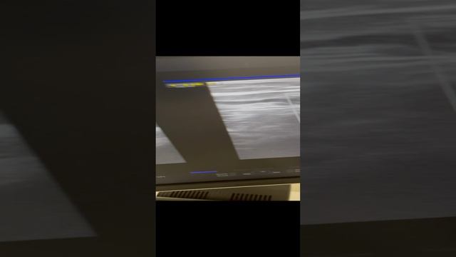 Варикоз после беременности. Узи сосудов. Флеболог. Флеболог Москва. Сосудистый хирург Москва смотреть онлайн