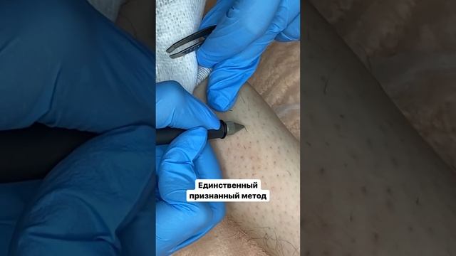 Только электроэпиляция избавляет от волос навсегда ?#электроэпиляция смотреть онлайн