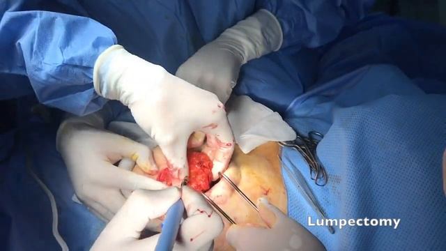 Bilateral Breast cancer:
Bilateral Lumpectomy with Sentinel lymph node biopsie by Round block смотреть онлайн