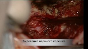 Микрохирургическое удаление фораминальной поясничной грыжи диска из латерального доступа