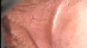 Паховая эпидермофития © Epidermophytosis