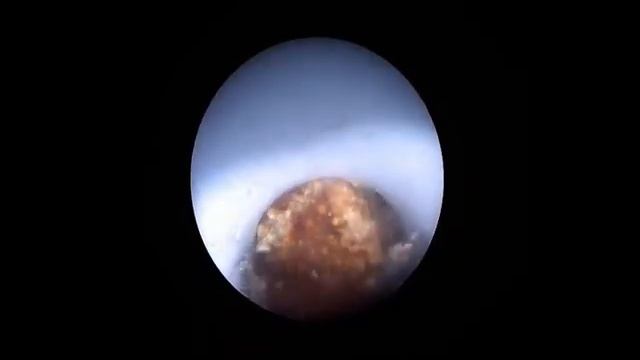 Percutaneous pneumatic nephrolithotripsy (PCNL) by Omer OGE, MD, Izmir смотреть онлайн