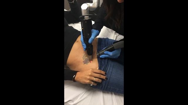 Picosure Tattoo Removal on the Hip | Nazarian Plastic Surgery смотреть онлайн
