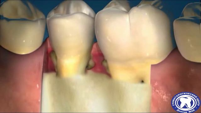 Что такое Гингивит и как его лечат смотреть онлайн