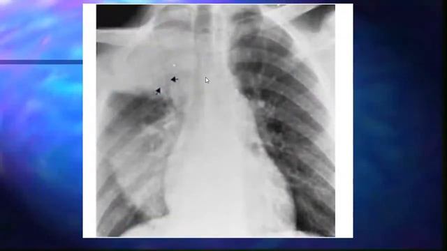 Manejo del Paciente Crítico 2020 - Diagnóstico y Manejo de la Insuficiencia Respiratoria Aguda 1/1 смотреть онлайн