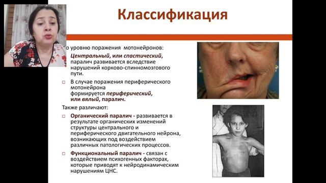 Пирамидный путь Центральные и периферические параличи смотреть онлайн