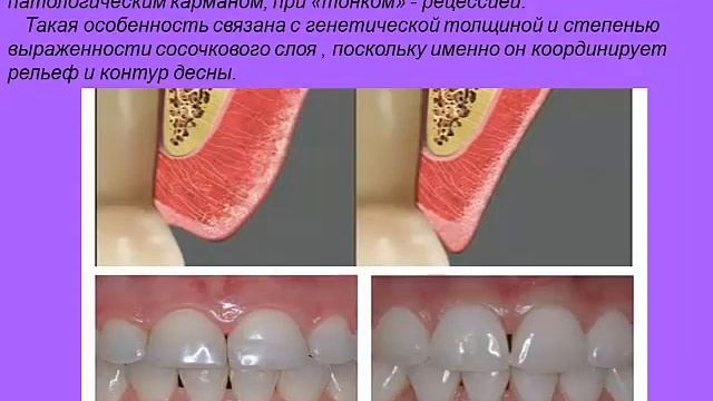 Пародонт Строение и функции Классификация заболеваний пародонта Клиника, диагностика смотреть онлайн