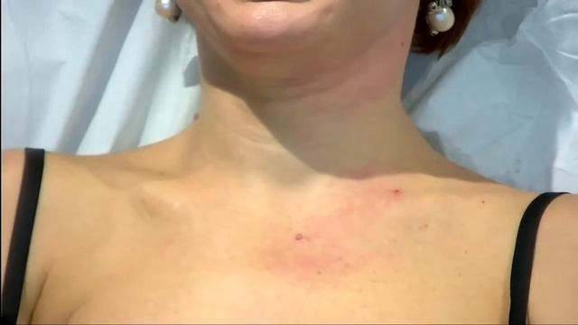 Collagen Replacement Therapy | Karisma | Practica смотреть онлайн