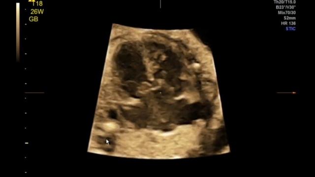 Trisomy 18 3 смотреть онлайн