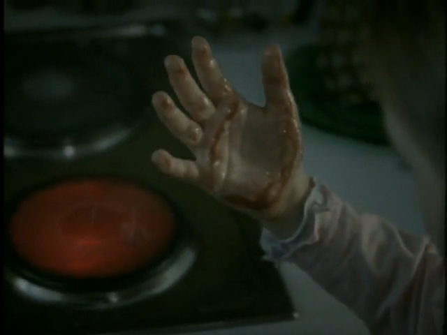 Девочка обожгла ладонь "до мяса" смотреть онлайн