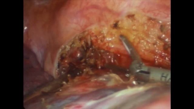 Asvide: Unidirectionally progressive left pneumonectomy & mediastinal lymph node dissection. смотреть онлайн