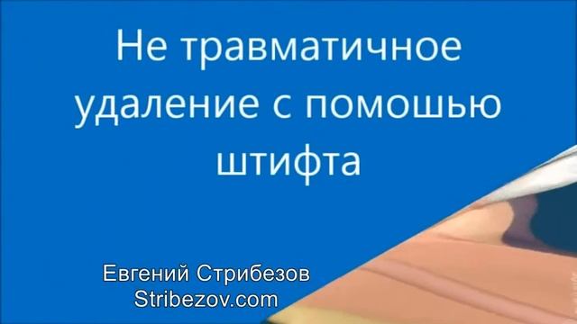 Сложное удаление зуба Спб смотреть онлайн