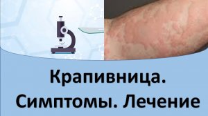 Крапивница. Симптомы и лечение.
