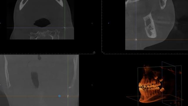Lymph node calcification in CBCT смотреть онлайн