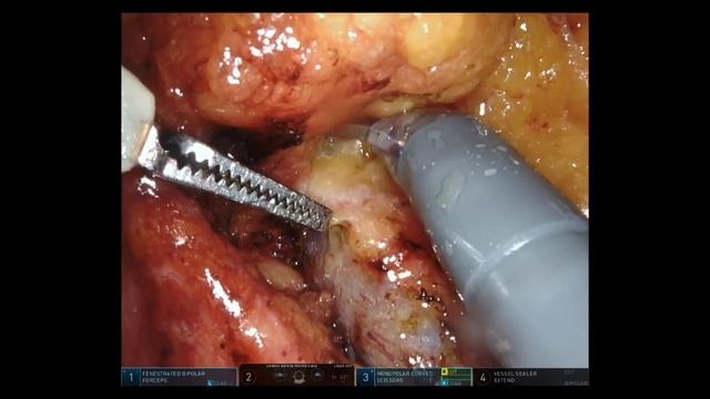 Robotic D3 lymph node dissection of superior mesentery vessels. смотреть онлайн