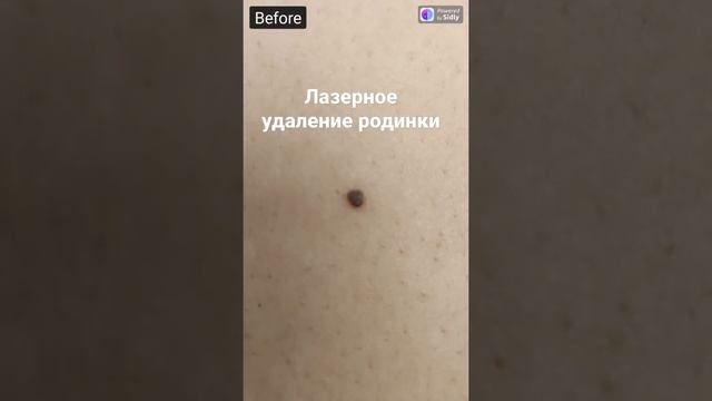 Удаление родинки (невуса) лазером | Laser removal of a nevus смотреть онлайн