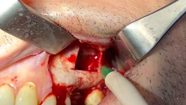 SinusLift Dr. Casadei Matteo смотреть онлайн