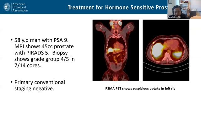 Treatment for Hormone Sensitive Prostate Cancer (2023) - English смотреть онлайн