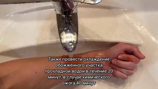 Оказание первой помощи при ожоге руки
