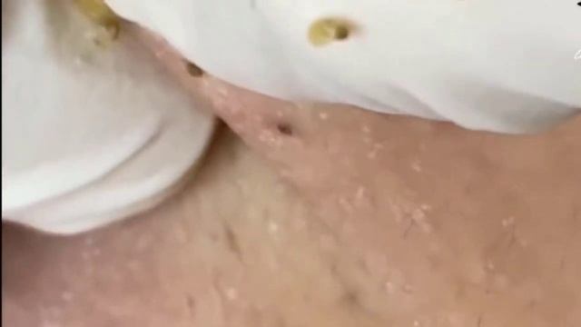 Pimple Popping - Skin Care