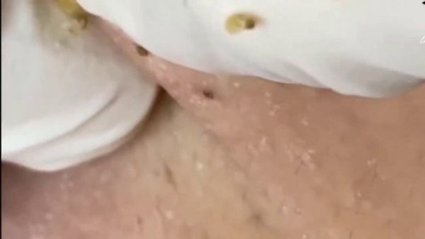 pimple popping - skin care