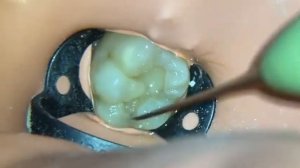 Как Удаляют Нерв из зуба слабоннервным не смотреть