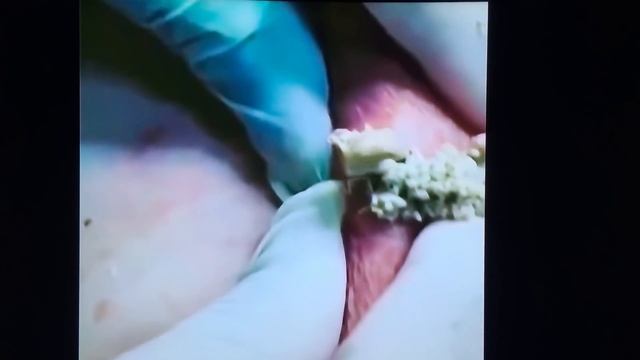 Подборка гнойных прыщей! Pimples! Acne! смотреть онлайн