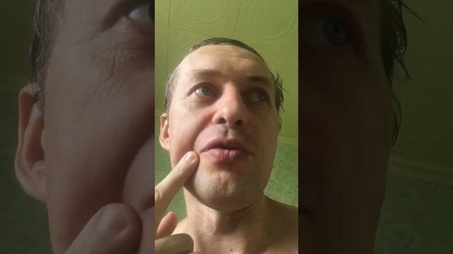 Поел малины и снова стали проявляться высыпания на лице