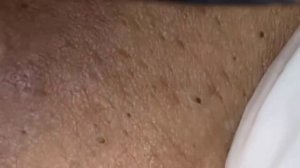 Удаление черных точек 2022 EP07