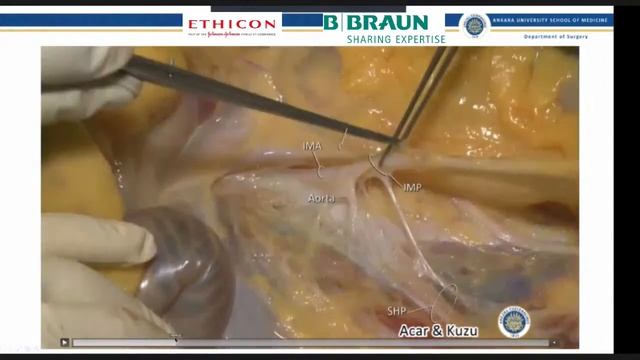 "STEPS course in laparoscopic colorectal surgery" с профессорами A.Parvaiz и A.Kuzu смотреть онлайн